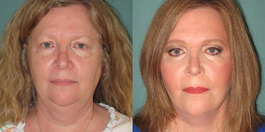 FACELIFT SURGERY IN CHICAGO: NATURAL IS KEY
