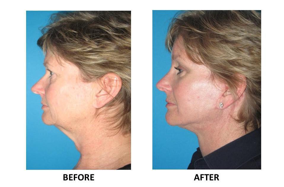 FACELIFT SURGERY IN NORTHFIELD – REASONS TO GET A FACELIFT