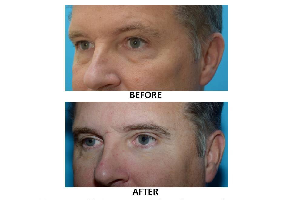 EYELID SURGERY IN CHICAGO – ADVANTAGES OF EYELID SURGERY