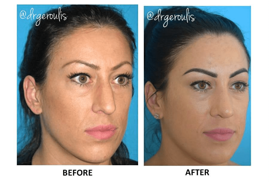 RHINOPLASTY IN CHICAGO – RHINOPLASTY FACTS YOU SHOULD KNOW ABOUT