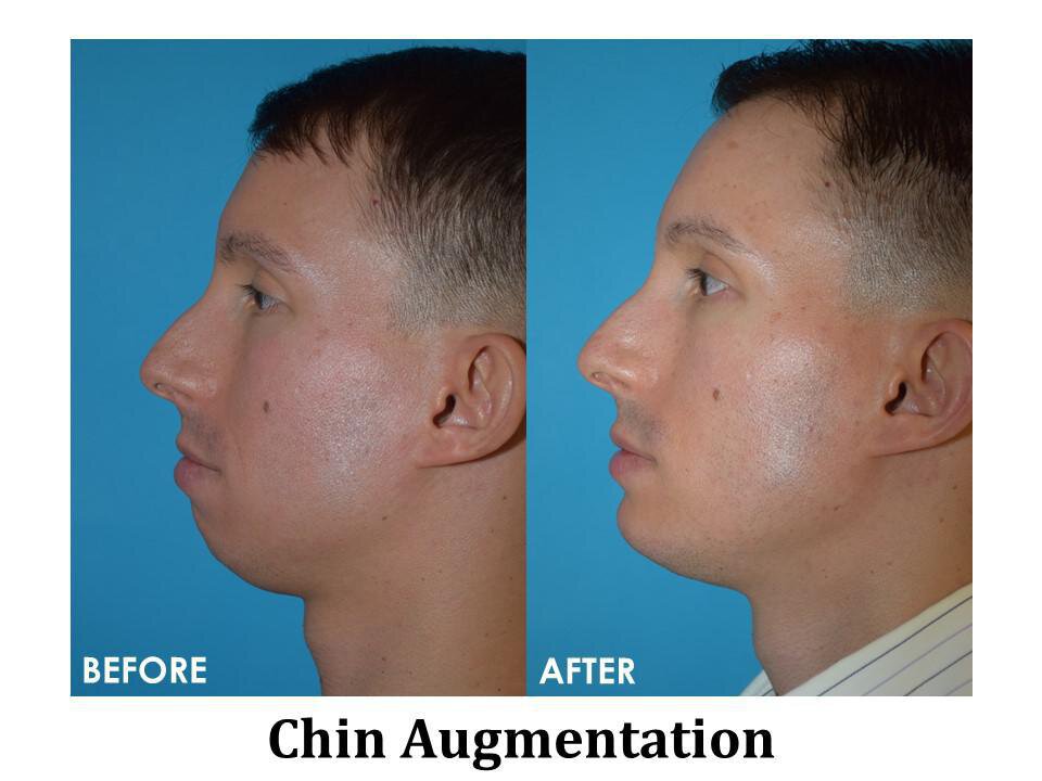 CHIN AUGMENTATION ON THE RISE