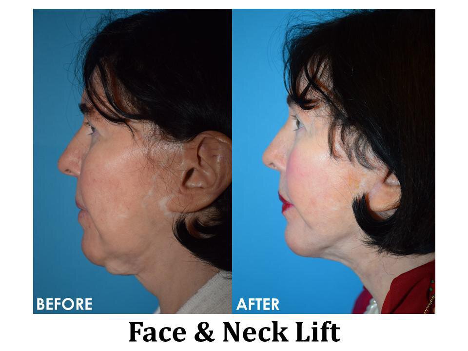 Face & Neck Lift in the Chicago North Shore