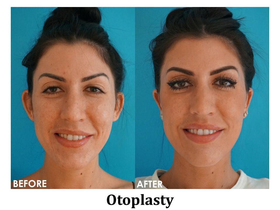 Otoplasty: Subtle, Safe, & Significant