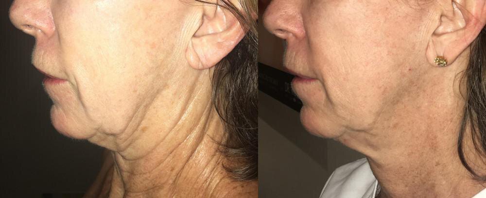 MORPHEUS8 - Skin Tightening Without Surgery!