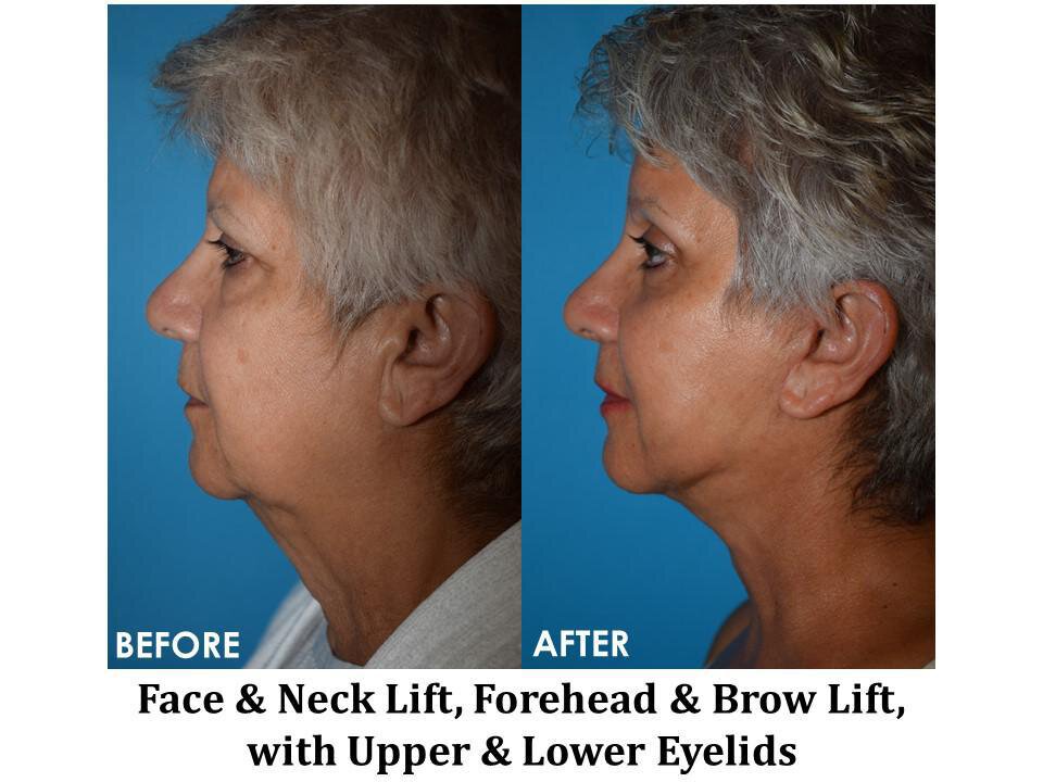 Dr. Anthony Geroulis - The Facelift Expert