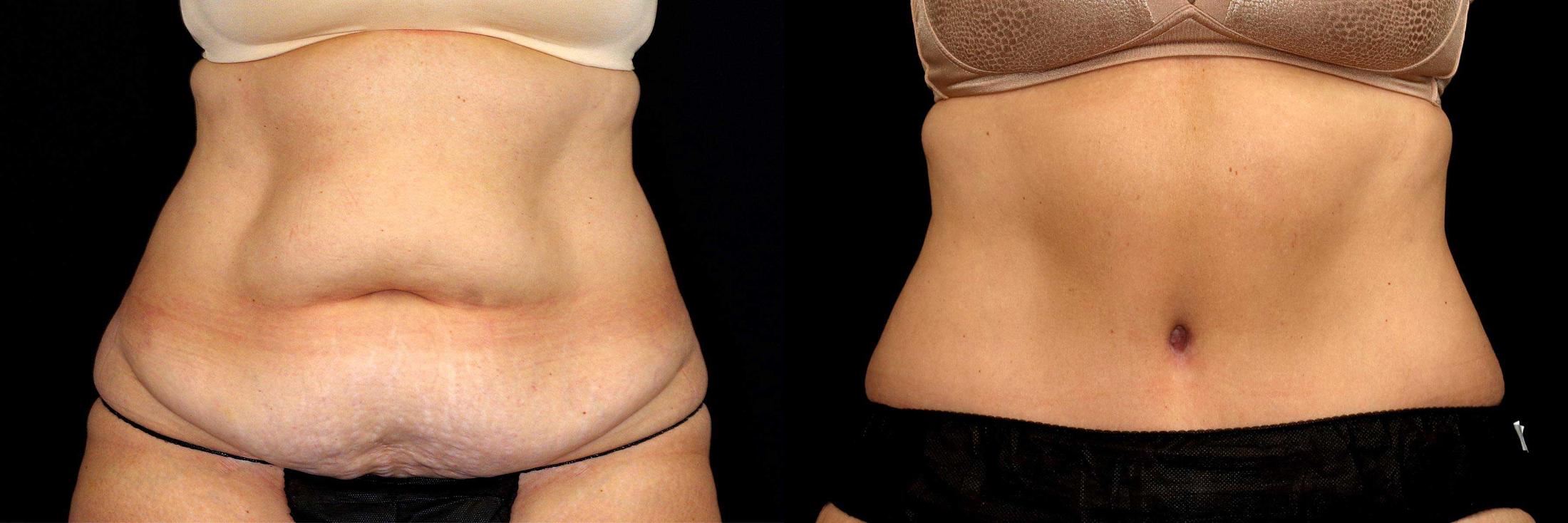 before and after tummy tuck