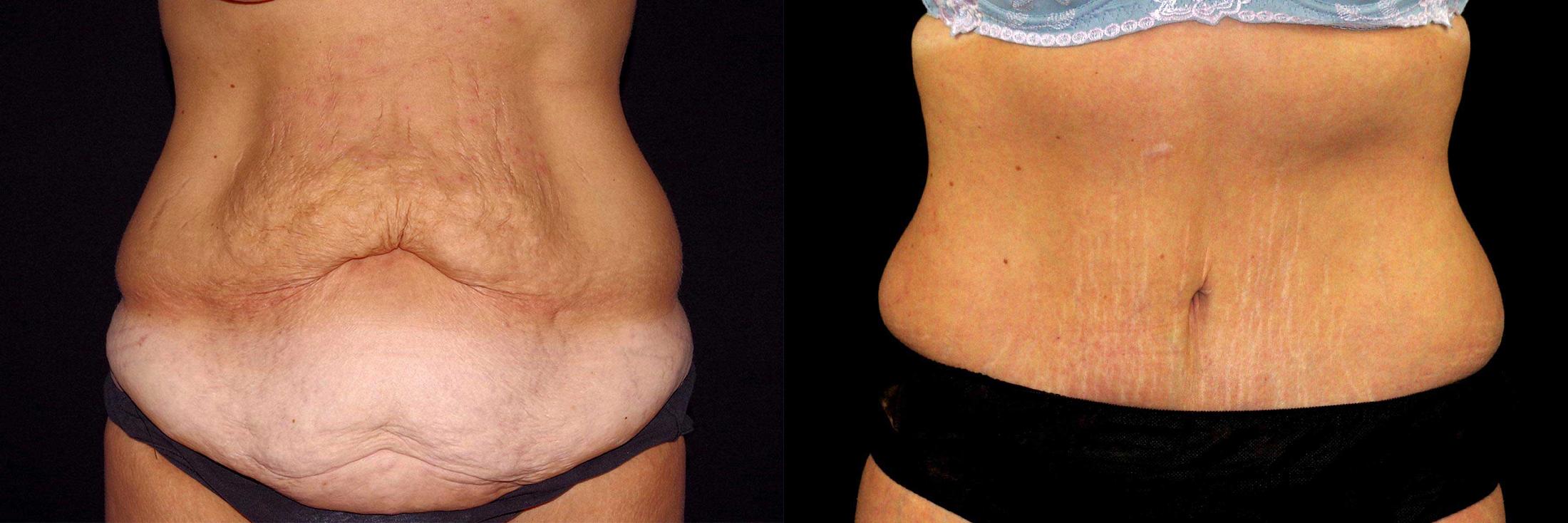before and after tummy tuck