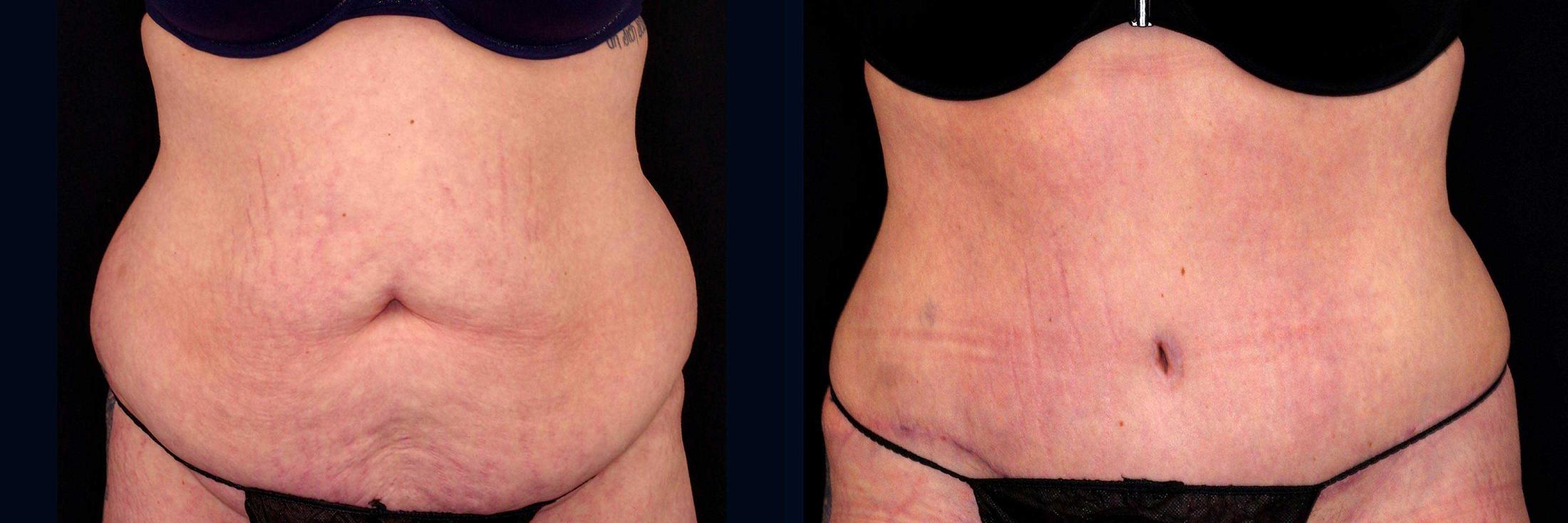 before and after tummy tuck
