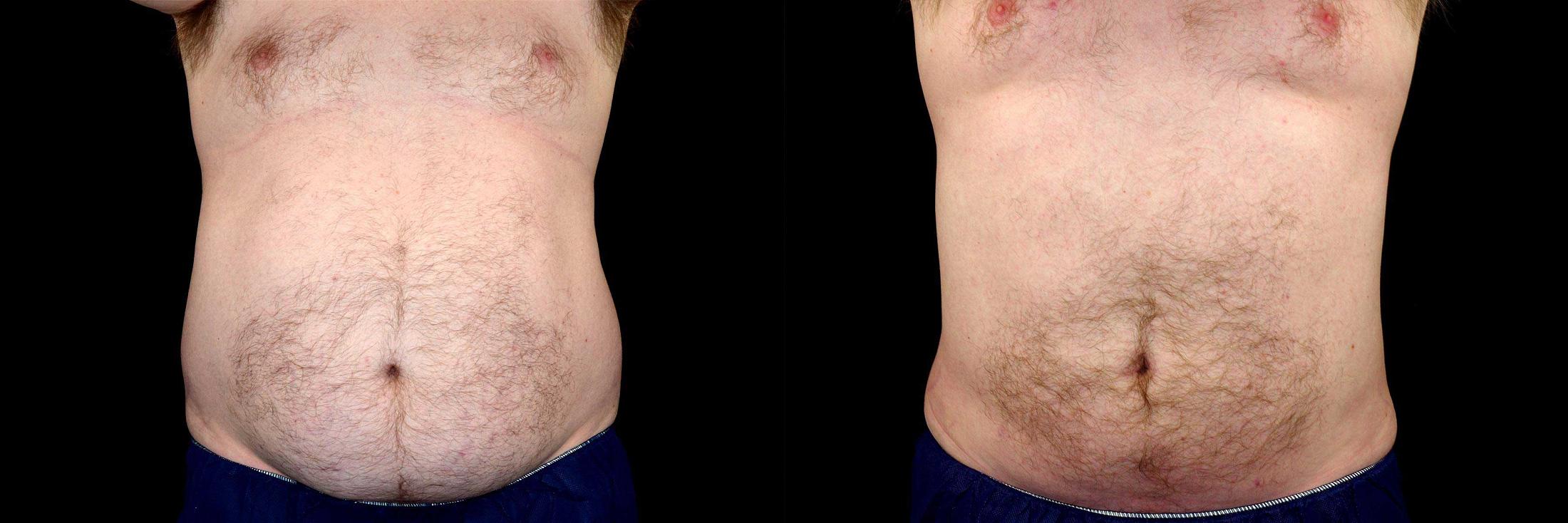 before and after liposuction