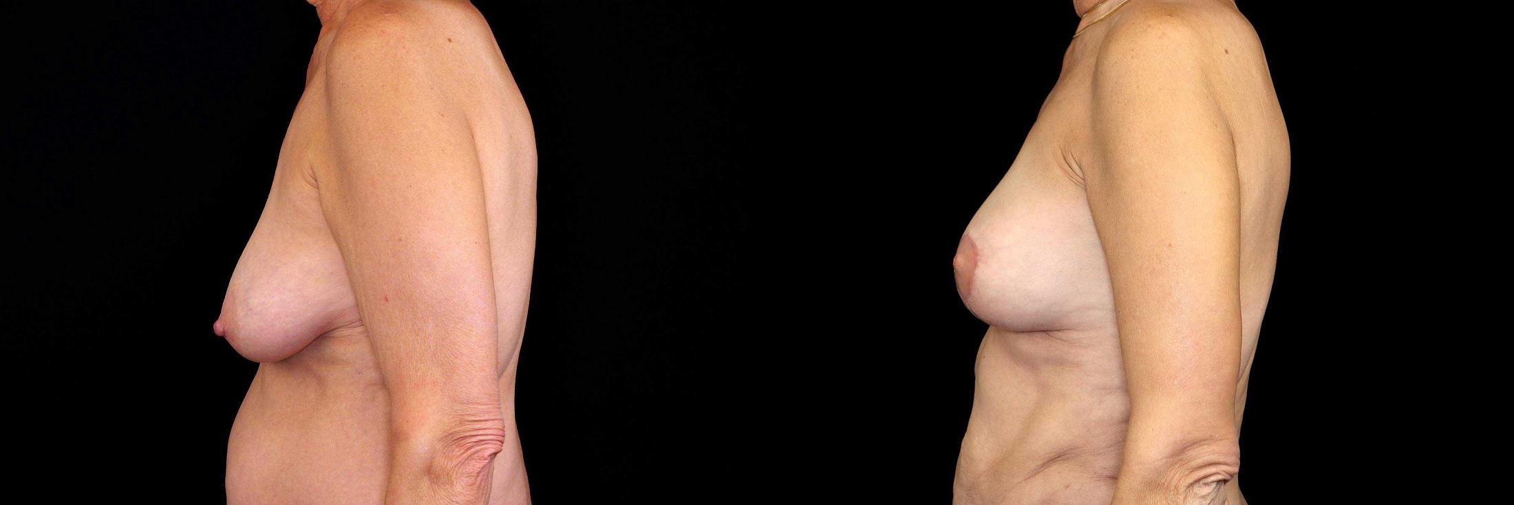 before and after fat transfer