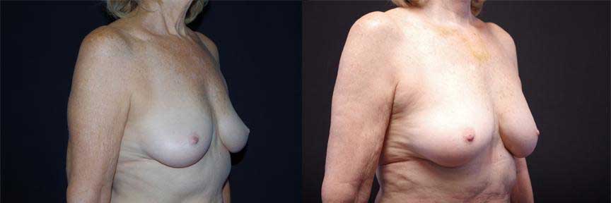 before and after fat transfer