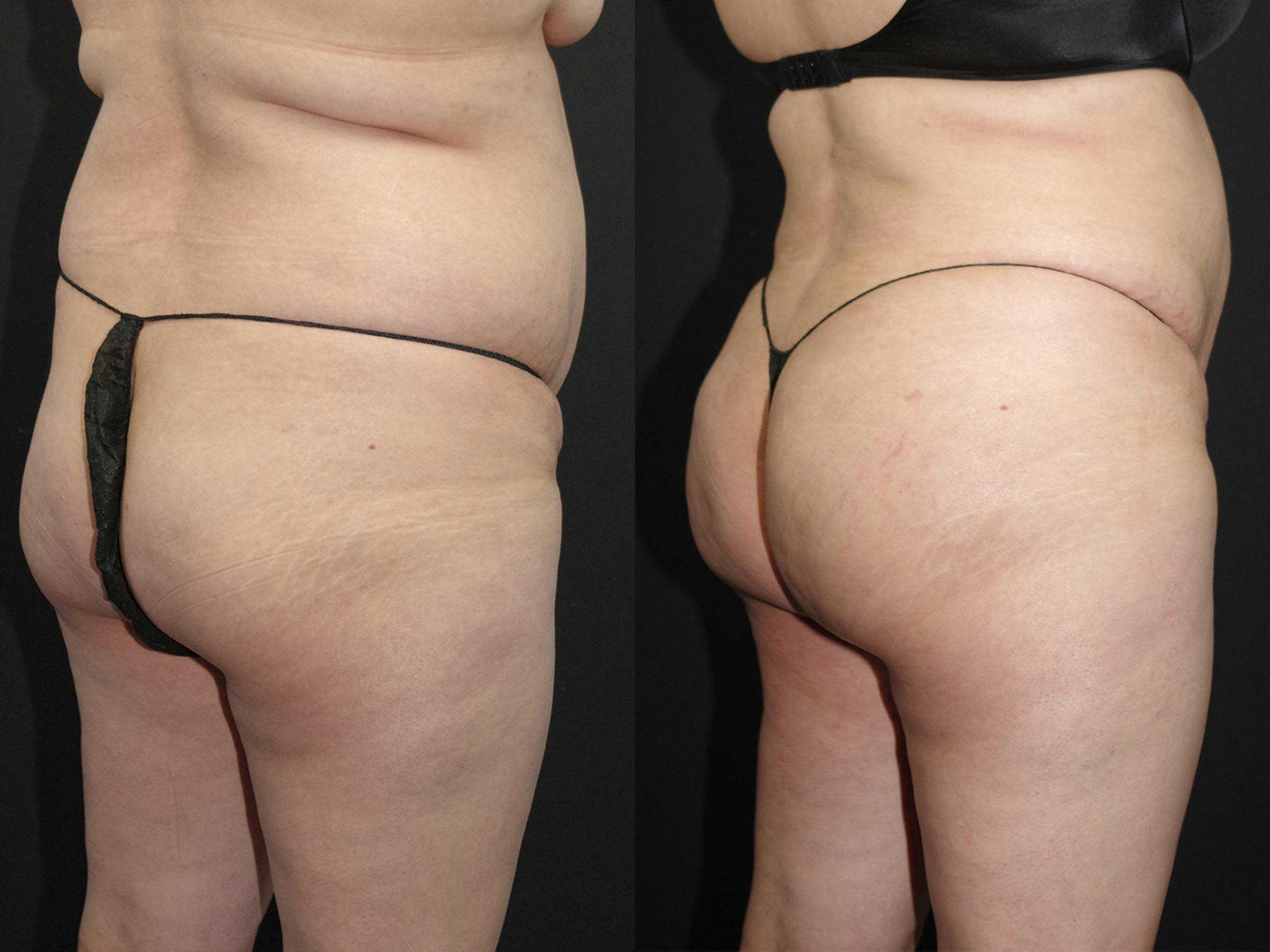 before and after bbl