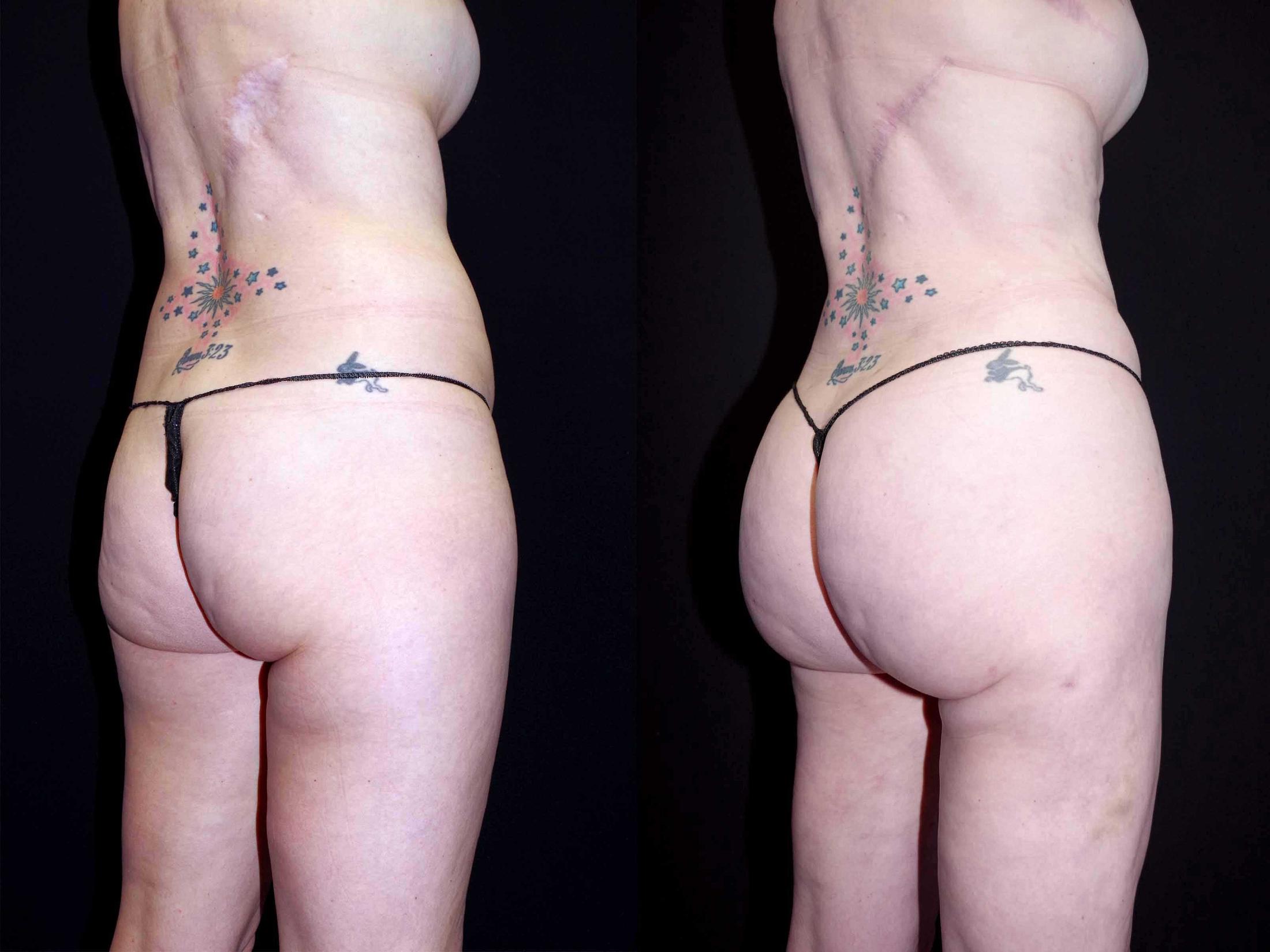 before and after bbl