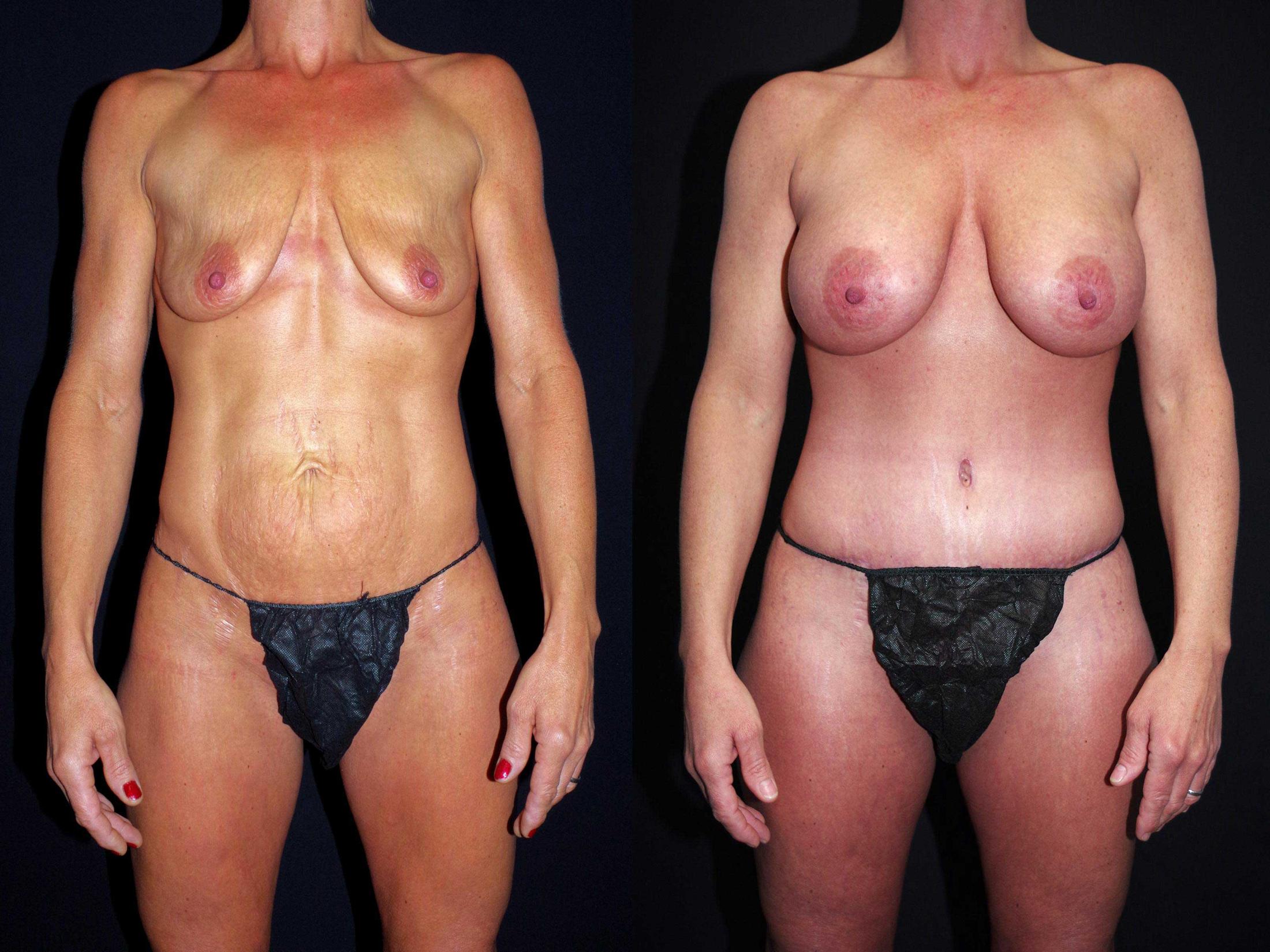 before and after mommy makeover