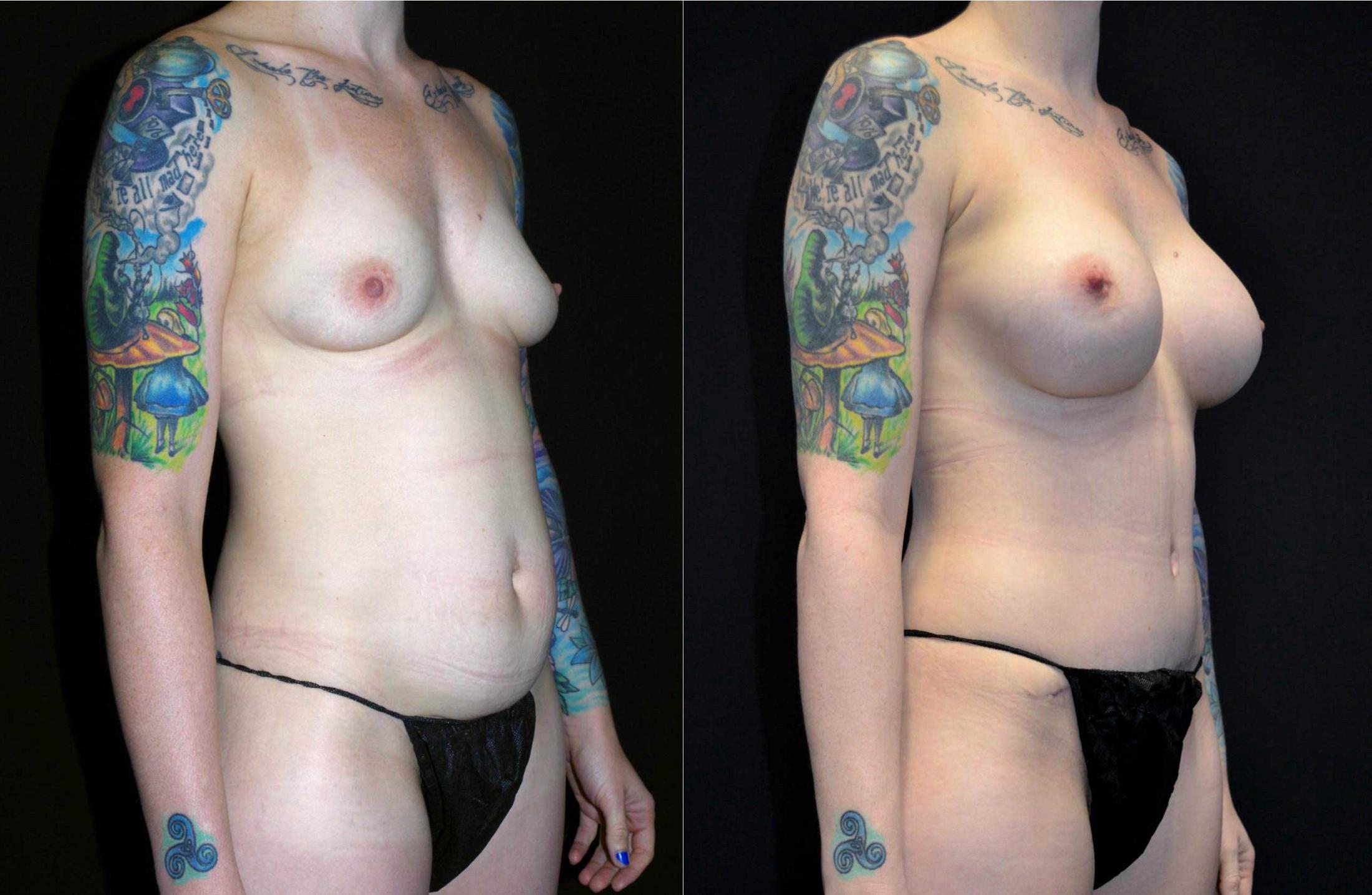 before and after mommy makeover