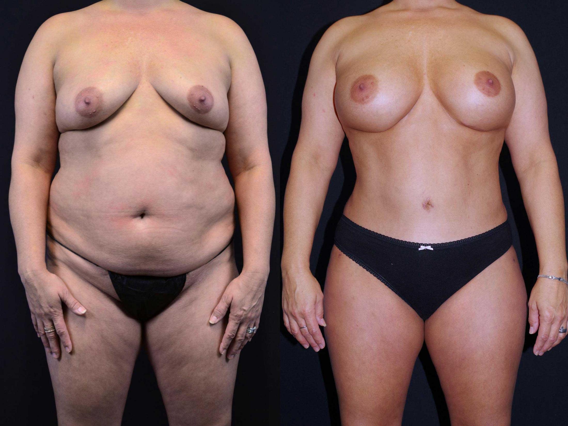 before and after mommy makeover