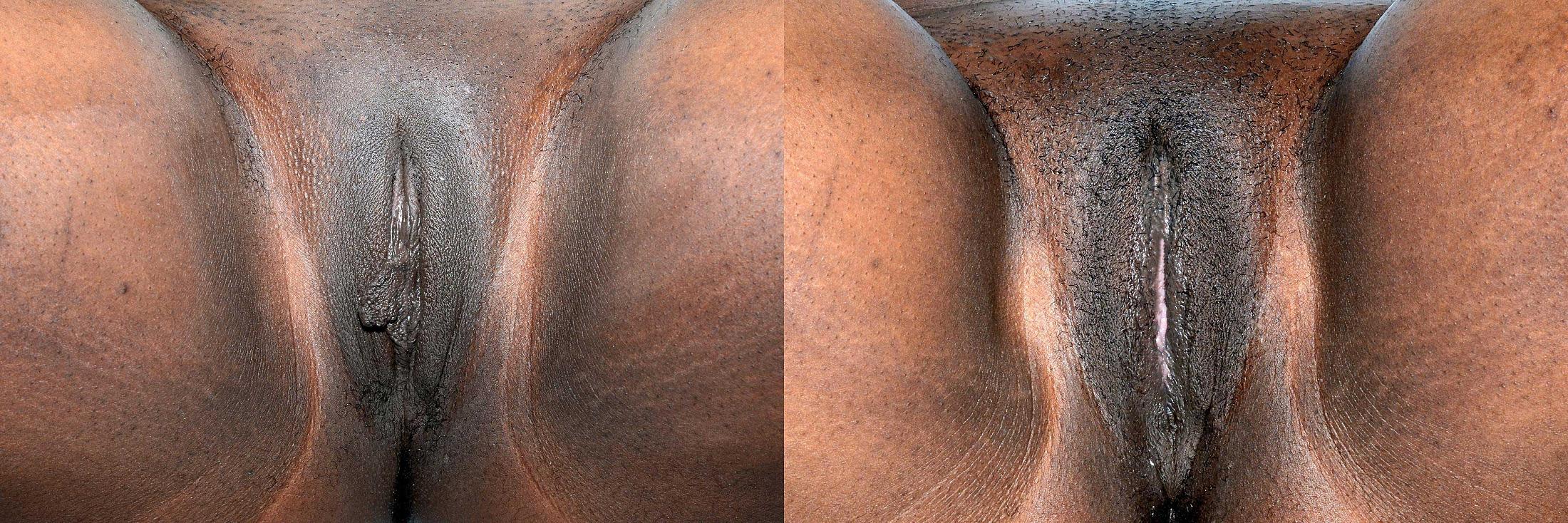 before and after labiaplasty