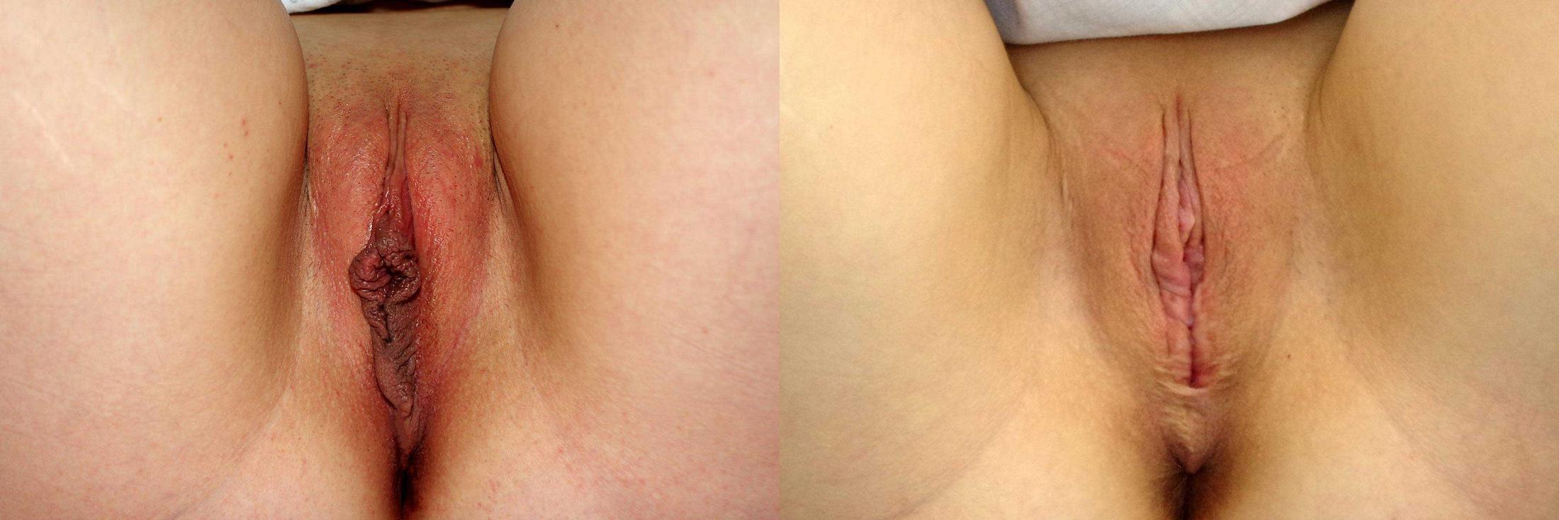 before and after labiaplasty