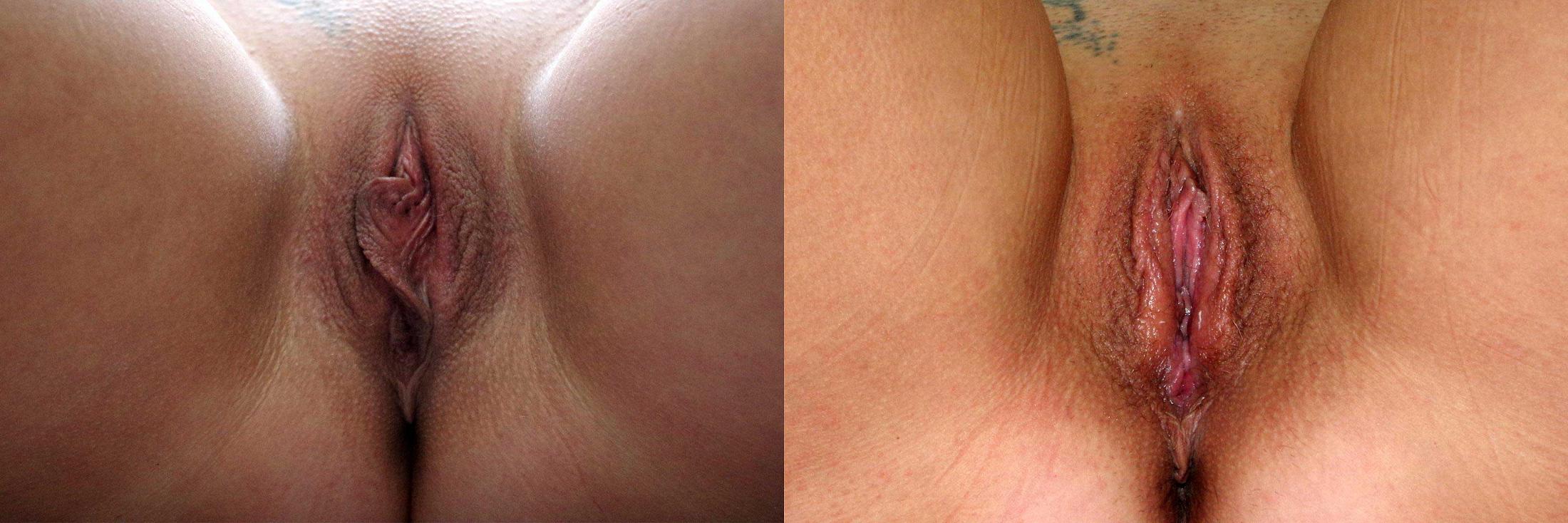 before and after labiaplasty