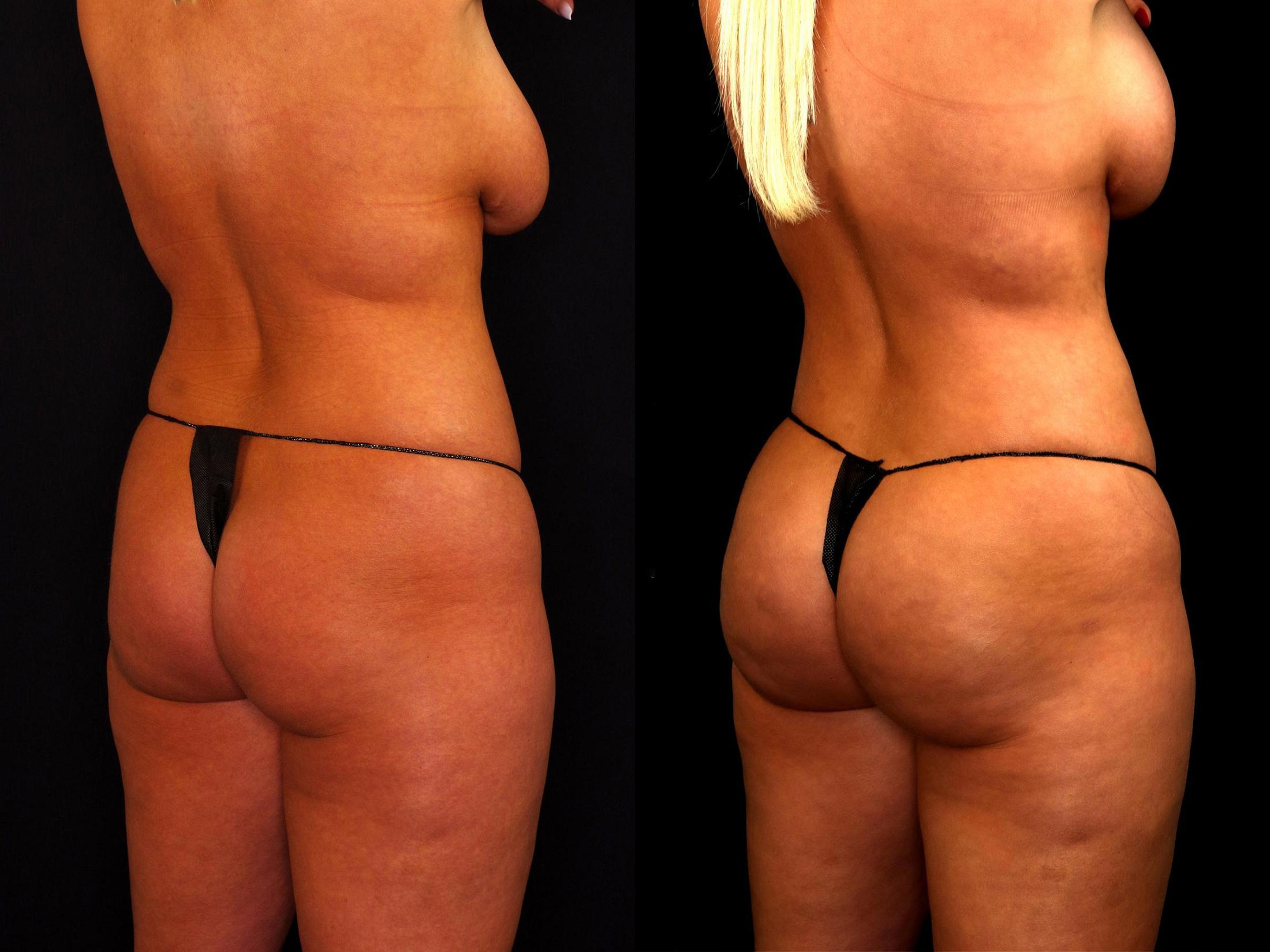 before and after bbl