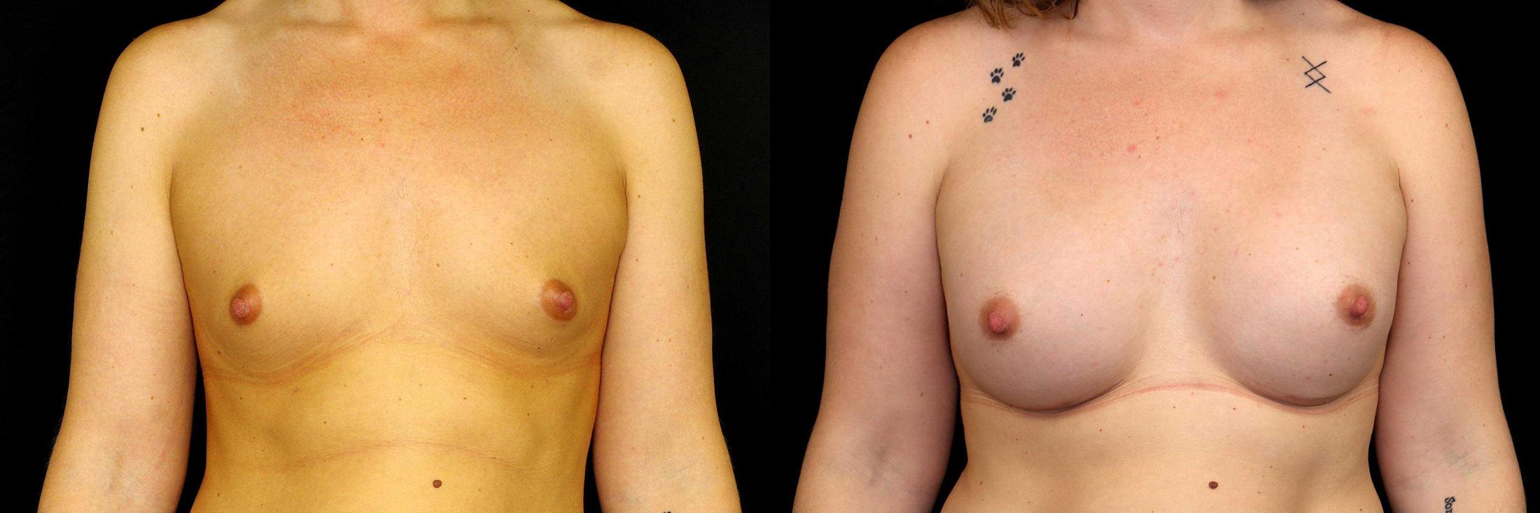 before and after breast augmentation