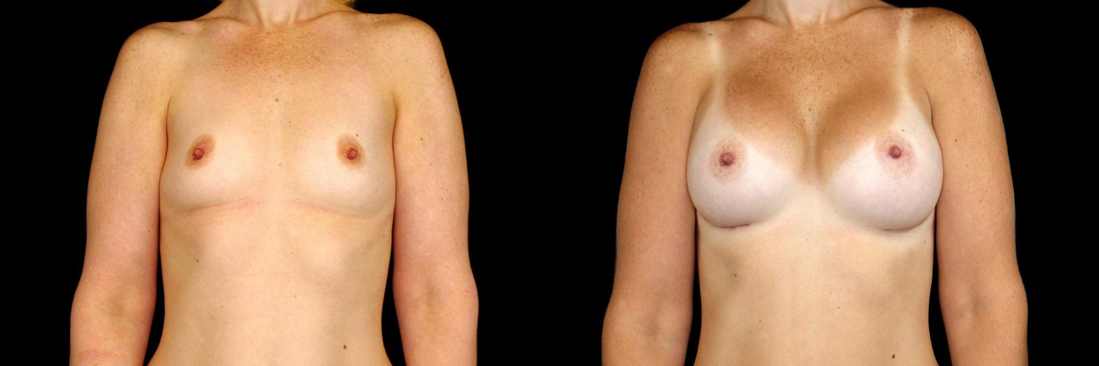 before and after breast augmentation