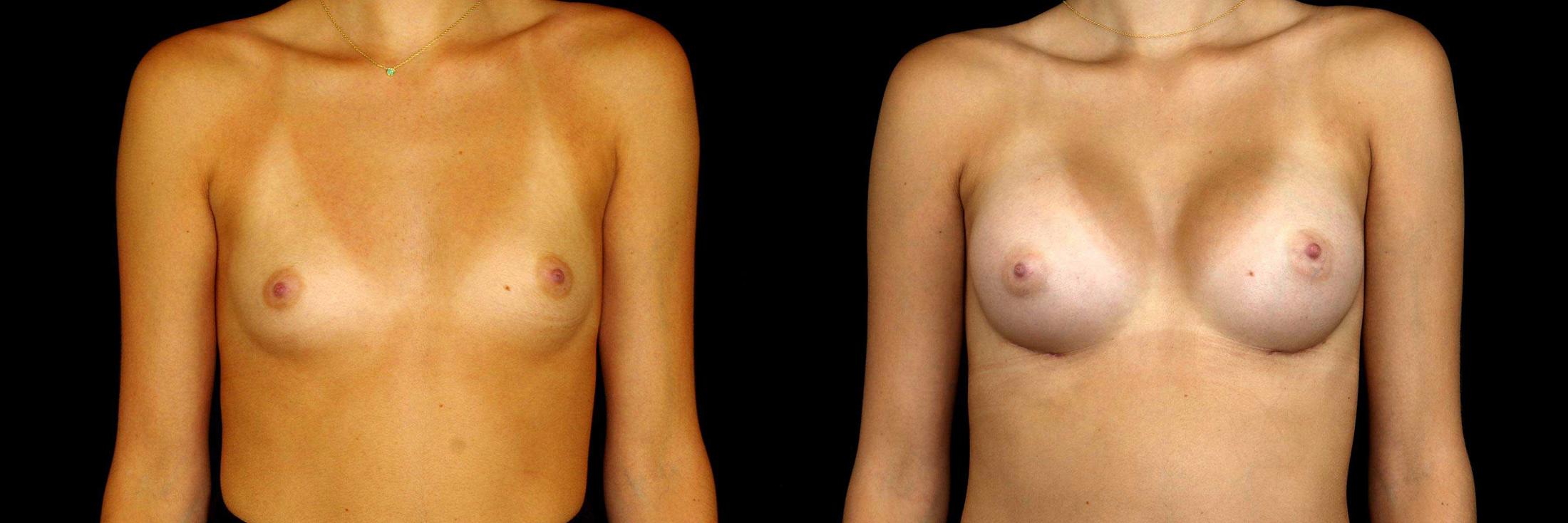 before and after breast augmentation