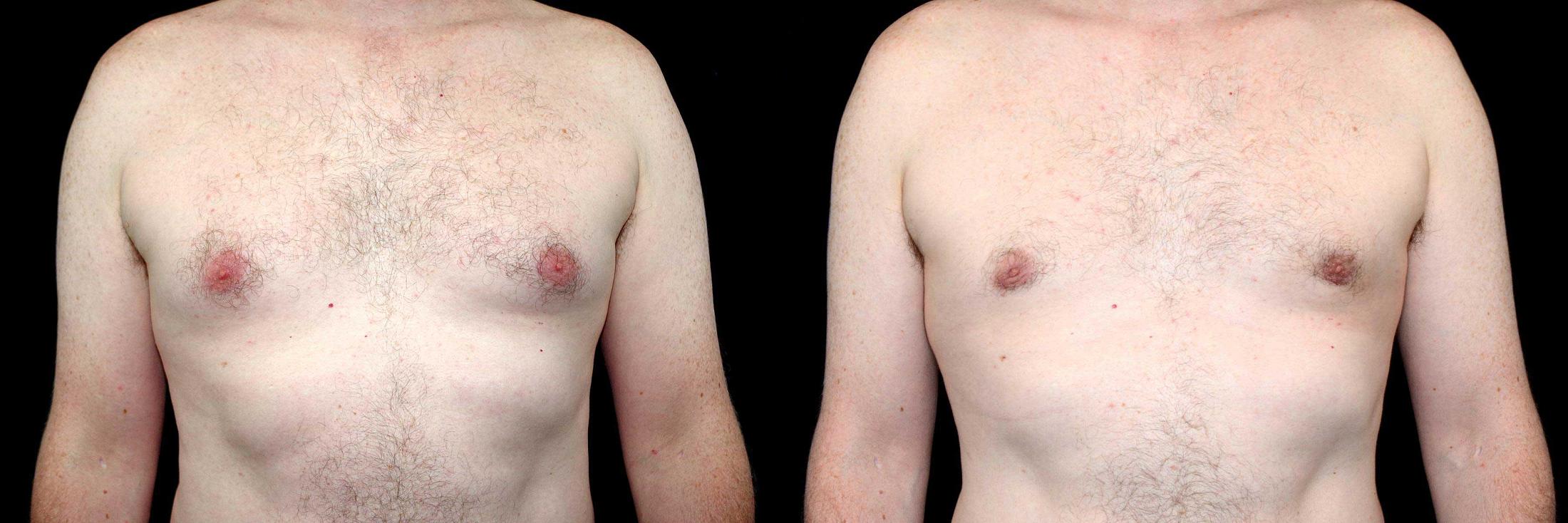 before and after gynecomastia surgery