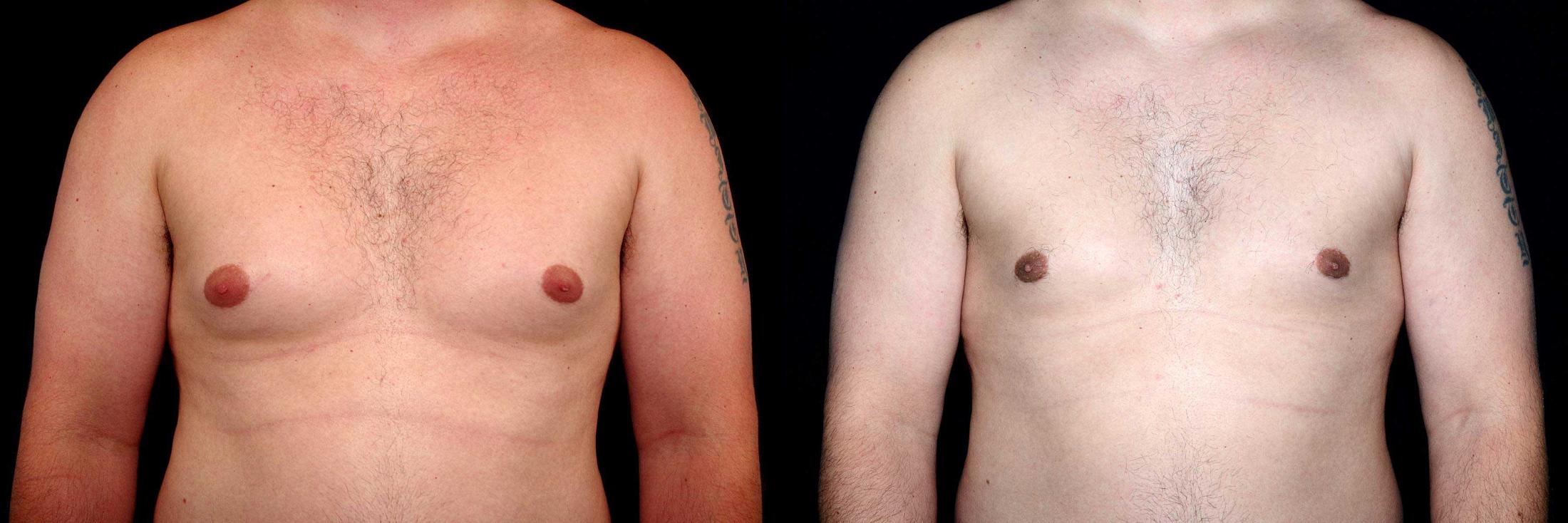 before and after gynecomastia surgery