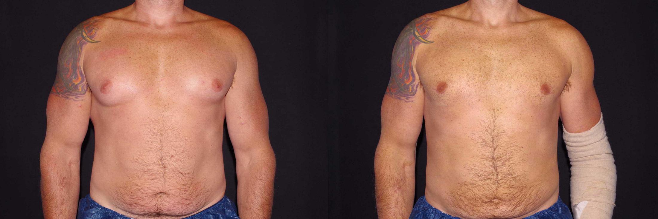 before and after gynecomastia surgery