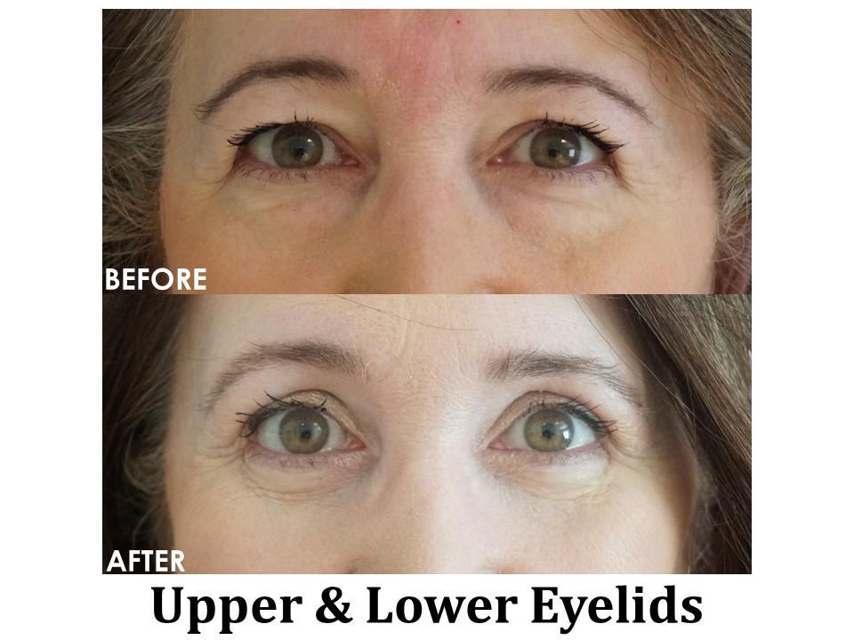 Blepharoplasty Before & After Image