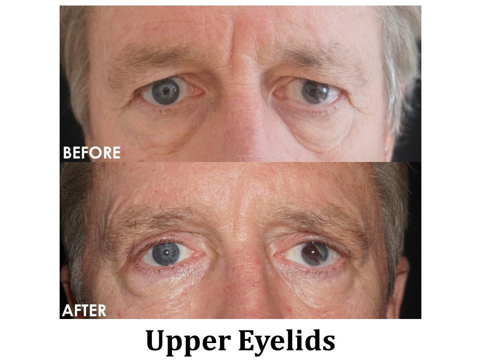 Blepharoplasty Before & After Image