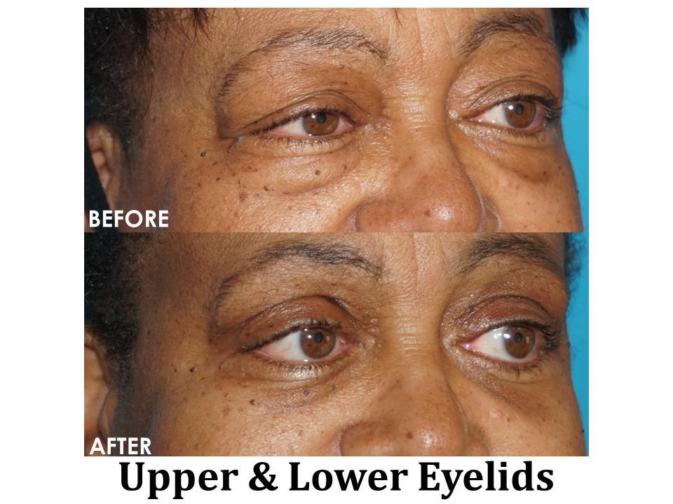 Blepharoplasty Before & After Image