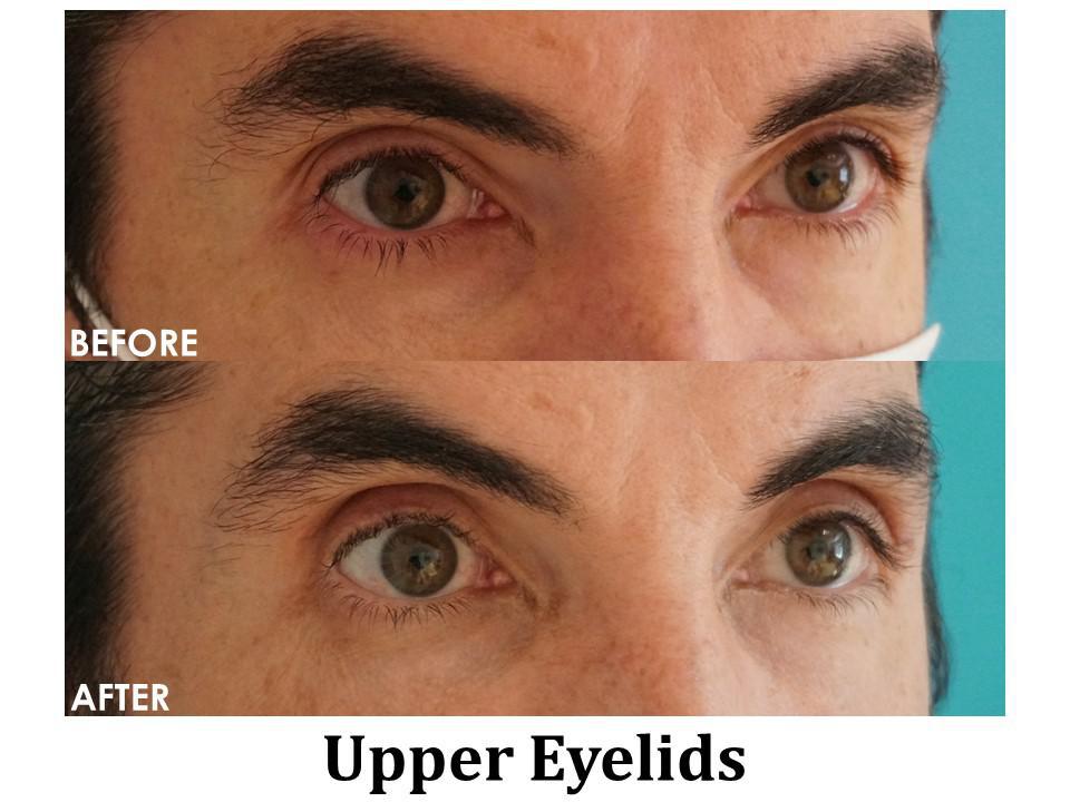 Blepharoplasty Before & After Image