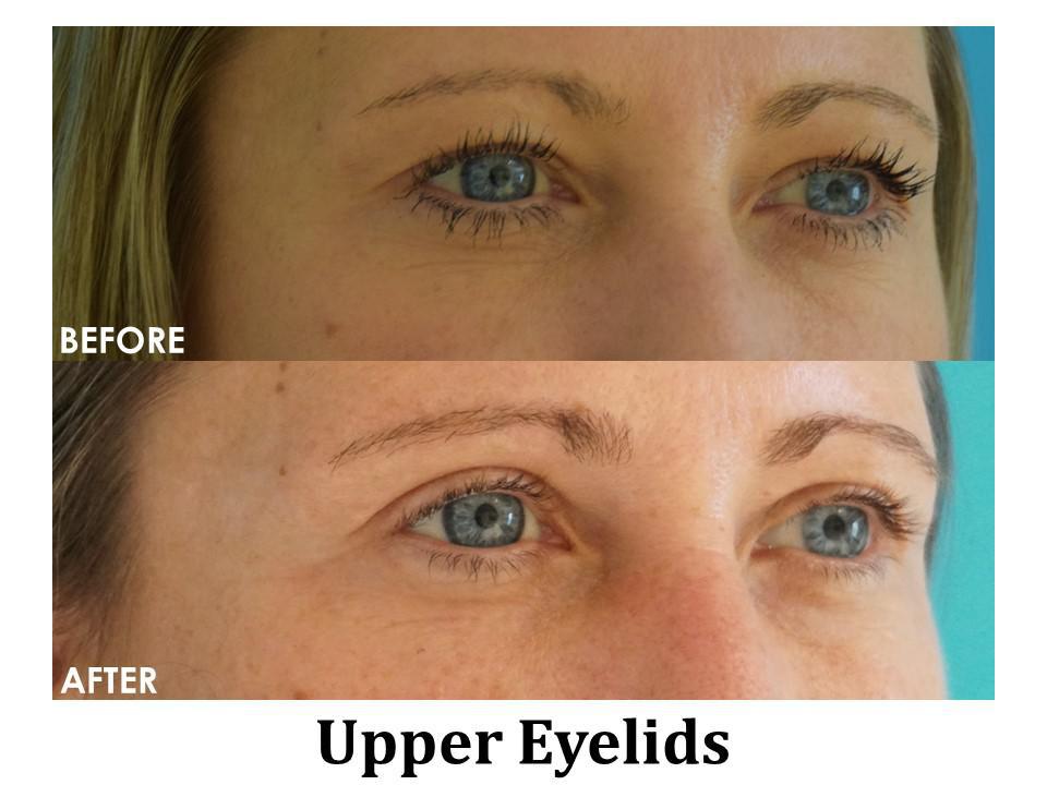 Blepharoplasty Before & After Image