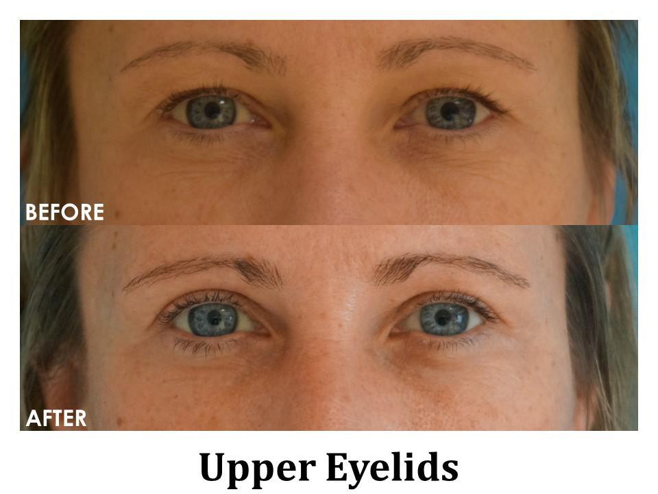 Blepharoplasty Before & After Image