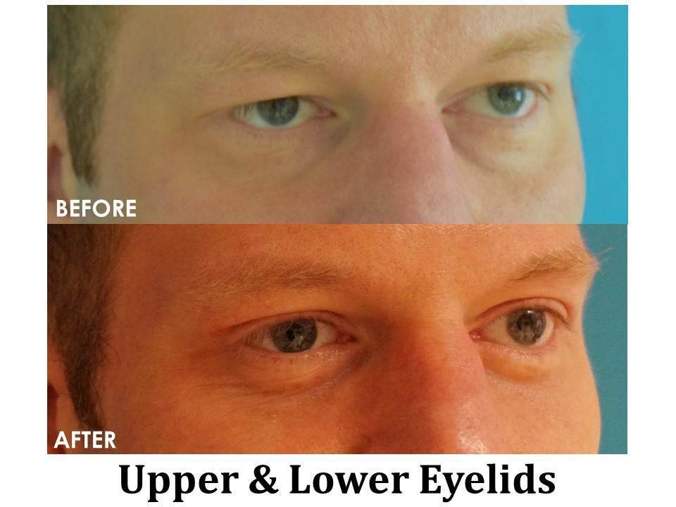 Blepharoplasty Before & After Image
