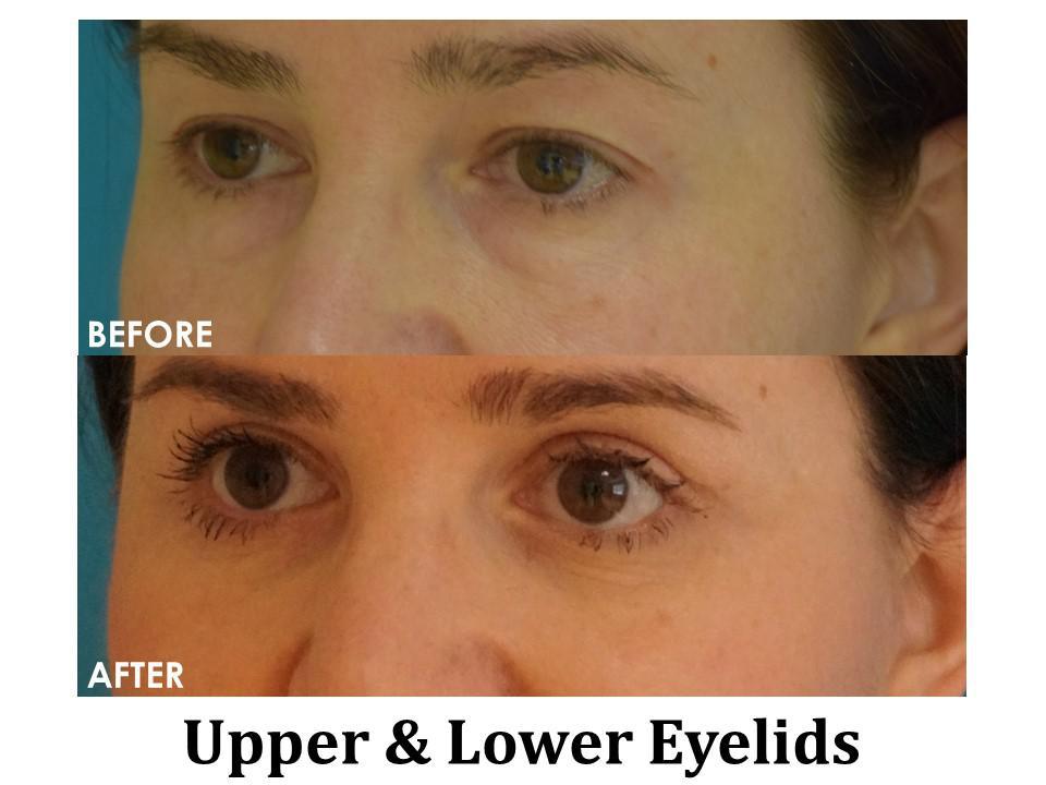 Blepharoplasty Before & After Image