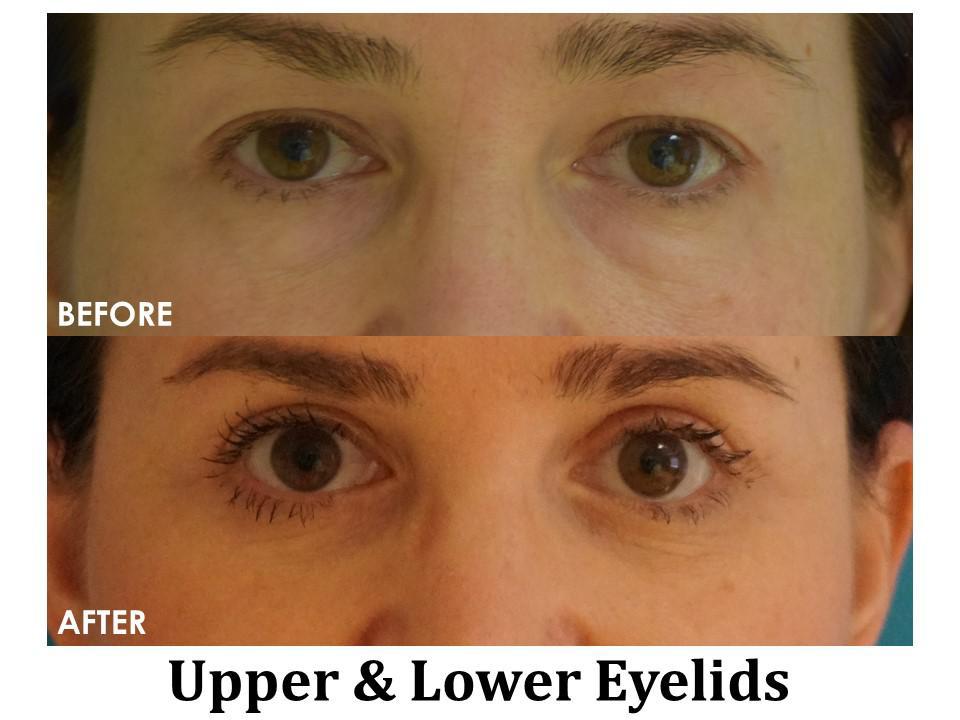 Blepharoplasty Before & After Image