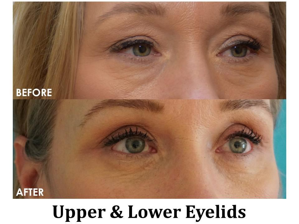 Blepharoplasty Before & After Image