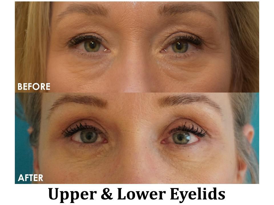 Blepharoplasty Before & After Image