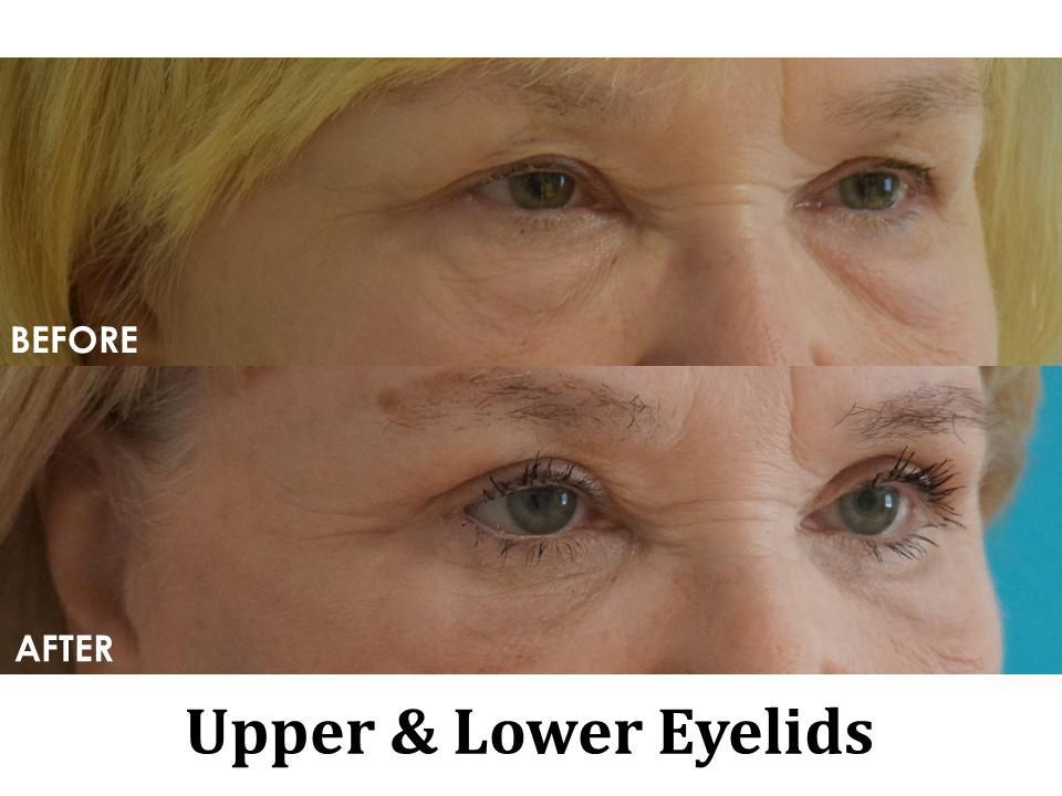 Blepharoplasty Before & After Image