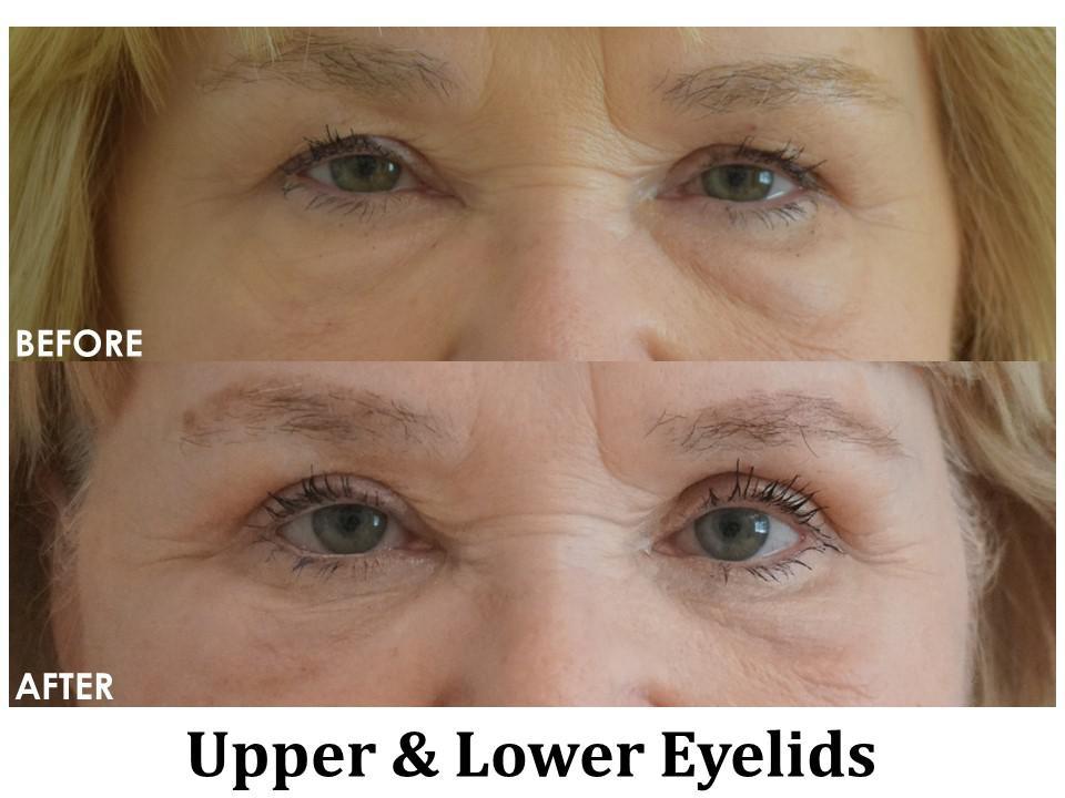 Blepharoplasty Before & After Image