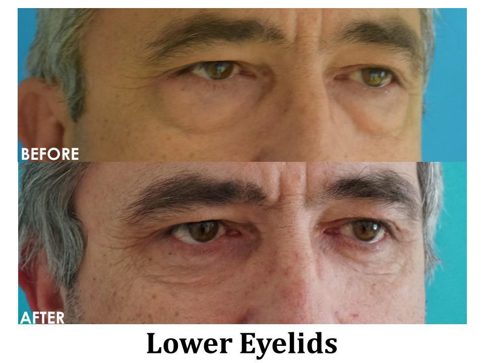 Blepharoplasty Before & After Image
