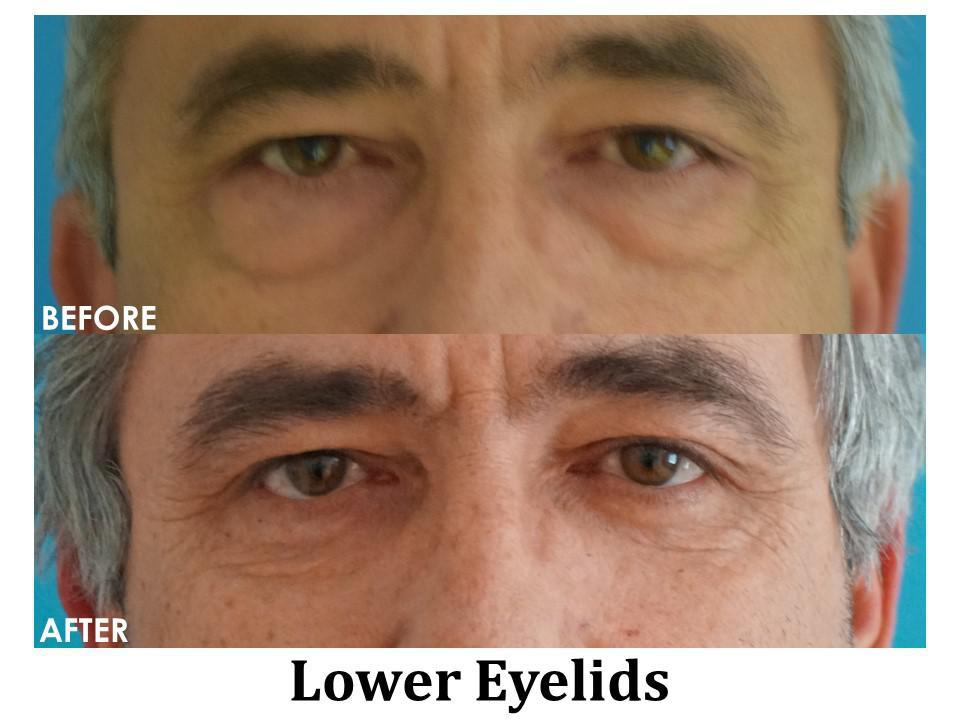 Blepharoplasty Before & After Image