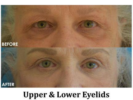 Blepharoplasty Before & After Image