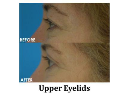 Blepharoplasty Before & After Image