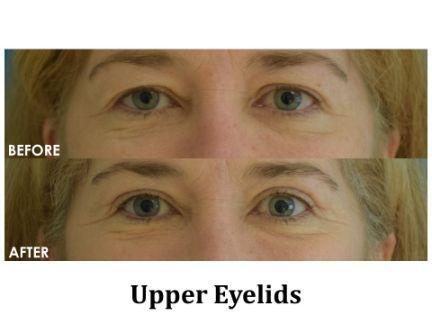 Blepharoplasty Before & After Image