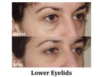 Blepharoplasty Before & After Image