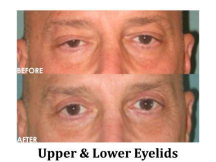Blepharoplasty Before & After Image